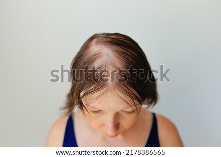 Hair loss in the form of alopecia areata. Bald head of a woman. Hair thinning after covid. Bald patches of total alopecia Royalty-Free Stock Photo #2178386565