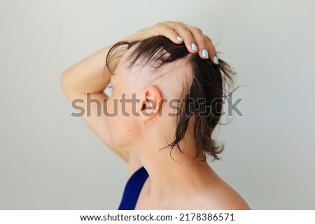 Hair loss in the form of alopecia areata. Bald head of a woman. Hair thinning after covid. Bald patches of total alopecia Royalty-Free Stock Photo #2178386571