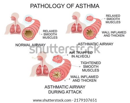 Pathology of asthma. Medical vector illustration. Royalty-Free Stock Photo #2179107651