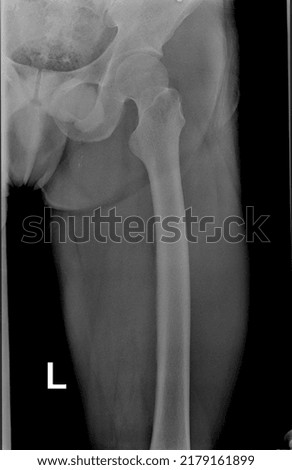 X-RAY The thighbone (femur).
the thighbone (femur) is the longest and strongest bone in the body. The femur consists of: head (head) Royalty-Free Stock Photo #2179161899
