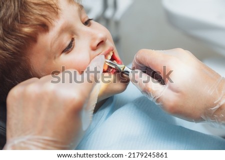 Portrait of a child patient and the hands of a pediatric dentist with dental forceps, close-up. painless extraction of teeth. pediatric dentistry. Royalty-Free Stock Photo #2179245861