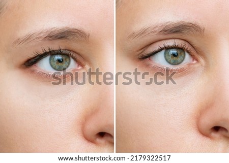 Close up of a young caucasian woman's face with drooping upper eyelid before and after blepharoplasty isolated on white background. Result of plastic surgery. Changing the shape, cut of the eyes Royalty-Free Stock Photo #2179322517