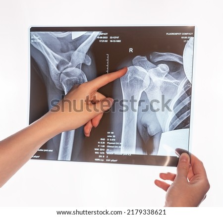 Forefinger pointing to trauma at shoulder, clavicle X-ray image. Acromion, acromial end fracture. Arm injury. Health care, medical examination concept. Broken bones detection. High quality photo Royalty-Free Stock Photo #2179338621