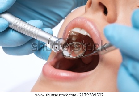A dentist doctor treats caries on a tooth of a young beautiful woman in a dental clinic. Tooth filling. Royalty-Free Stock Photo #2179389507