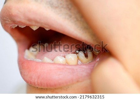 Metal Inlay. A type of Japanese dental treatment. Silver-colored artificial teeth. Treatment covered by insurance. Royalty-Free Stock Photo #2179632315