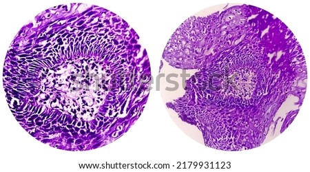 College of two Photomicrograph showing Colorectal cancer. Royalty-Free Stock Photo #2179931123