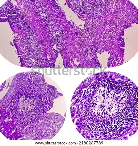 College of three Photomicrograph showing Colorectal cancer. Royalty-Free Stock Photo #2180267789