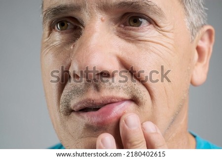 Allergic reaction to a bee sting. An unshaven man was stung by a bee and touches his face in the stung area close-up. Edema, swelling of the lower lip Royalty-Free Stock Photo #2180402615
