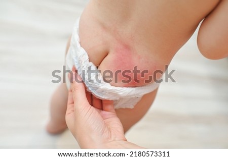 irritation on the skin of the baby from the diaper close-up. Royalty-Free Stock Photo #2180573311