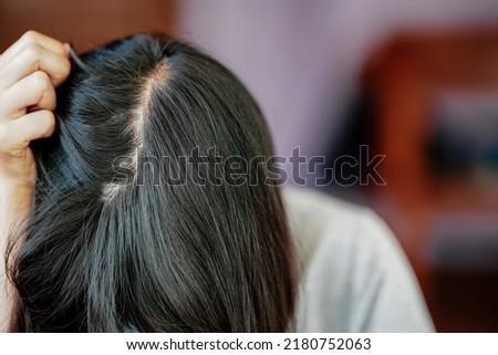 Woman catches her own hair that is falling and thin until the scalp is bald. Royalty-Free Stock Photo #2180752063