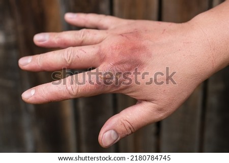 First degree skin burn. Hand burns, wounds. Selective focus, noise, film grain. Hot boiling water acts on the skin. Fresh burn, blister Royalty-Free Stock Photo #2180784745