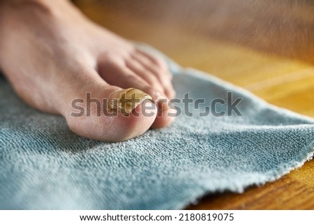 A medicinal solution is applied to the big toe affected by the fungus. Treatment of nail fungus.