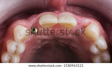 restored dental gingiva with gingiva former after implantation Royalty-Free Stock Photo #2180963121