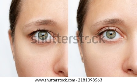Cropped shot of a young caucasian woman's face with drooping upper eyelid before and after blepharoplasty isolated on a white background. Result of plastic surgery. Changing the shape, cut of the eyes Royalty-Free Stock Photo #2181398563