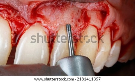 dental tool for bone during crown resection for veneers Royalty-Free Stock Photo #2181411357