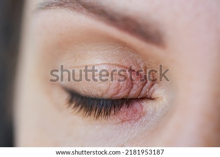 Peeling and swelling on the eyelid of the human eye from conjunctivitis Royalty-Free Stock Photo #2181953187