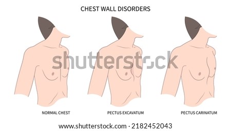 Marfan’s syndrome genetic condition disease Enlarged Heart syndrome malformation Gene Mutation Royalty-Free Stock Photo #2182452043