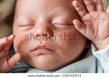 closeup of the face of a newborn baby with pimples on the cheeks due to accumulation of keratin. neonatal acne, milia, fattening. irritation and accumulation of pimples on the infant's face Royalty-Free Stock Photo #2182503951