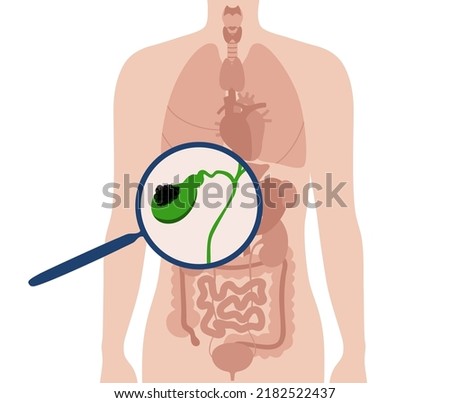 Gallbladder cancer concept. Inflammation in the digestive system and abdomen pain. Tumor cells in the human body. Internal organ examination in clinic or hospital. Medical flat vector illustration Royalty-Free Stock Photo #2182522437