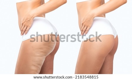 Fat woman with cellulite on her legs. Obese woman in white underwear.Overweight treatment.Photos in comparison before and after the treatment of overweight and cellulite.
