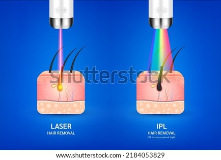 Skin layers anatomy with hairs. Laser and IPL light (Intense Pulsed Light) hair removal. Unwanted out make skin smooth. Used for beauty advertisements. Medical science concept. 3D Realistic vector. Royalty-Free Stock Photo #2184053829