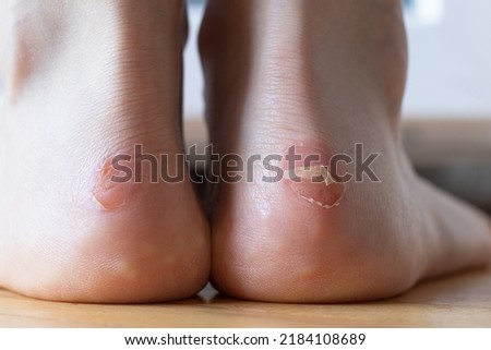 Blister on a barefoot female heel. A closeup. Painful dry callus on a woman's feet skin. Dermatology problem, uncomfortable skin condition. Royalty-Free Stock Photo #2184108689