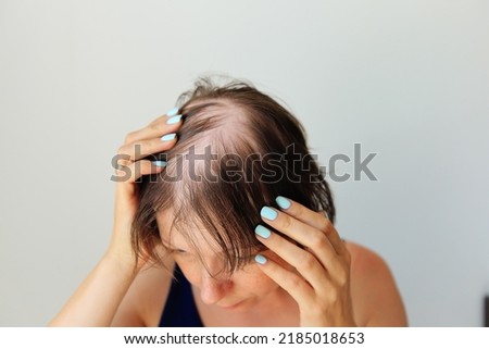 Hair loss in the form of alopecia areata. Bald head of a woman. Hair thinning after covid. Bald patches of total alopecia Royalty-Free Stock Photo #2185018653