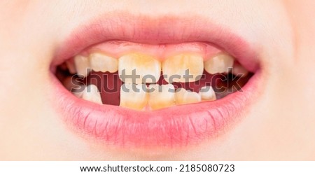 Close up of unhealthy baby teeths. Kid patient open mouth showing cavities teeth decay. Bad teeth child. Portrait boy with bad teeth. Child smile and show her crowding tooth. Royalty-Free Stock Photo #2185080723