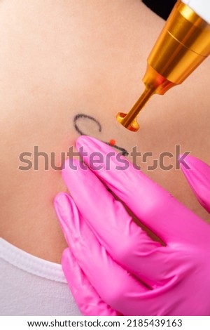The doctor cosmetologist makes the procedure for laser tattoo removal on the girl's body. Royalty-Free Stock Photo #2185439163