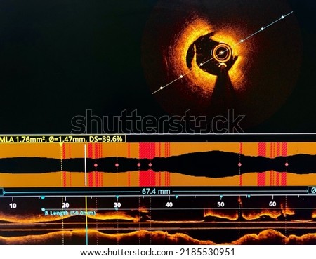 Intravascular imaging Optical Coherence Tomography (OCT) shown dissection in coronary artery. Royalty-Free Stock Photo #2185530951