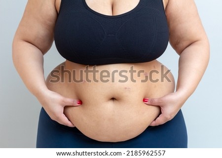 Obese young woman holds her belly recently operated on from sleeve bariatric surgery. Royalty-Free Stock Photo #2185962557
