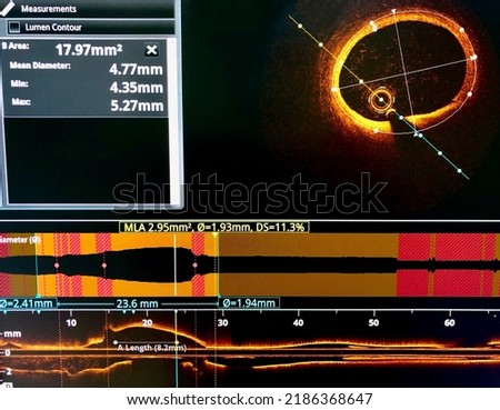 Intravascular imaging Optical Coherence Tomography (OCT) during cardiac catheterization. Royalty-Free Stock Photo #2186368647