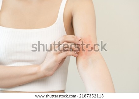 Dermatology asian young woman, girl allergy, allergic reaction from atopic, insect bites on her arm, hand in scratching itchy, itch red spot or rash of skin. Healthcare, treatment of beauty. Royalty-Free Stock Photo #2187352113