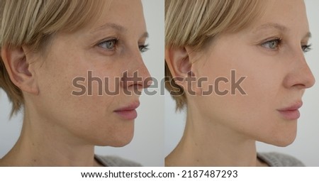 Woman face wrinkles before and after treatment Royalty-Free Stock Photo #2187487293