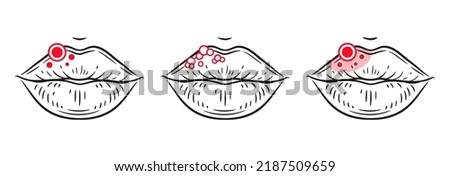 Herpes virus rash on lips, labial sore, inflammation skin face, stomatitis mouth line icon. Blister, ulcer, red acne, facial allergy reaction. Oral infection disease medical treatment. Skincare vector Royalty-Free Stock Photo #2187509659