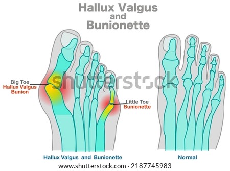 Hallux valgus, bunionette  anatomy. Foot bones, joint deformity feet. Top foot x ray, angle of  little pinky, big toe structure. Orthopedic patients surgery. Illustration vector Royalty-Free Stock Photo #2187745983