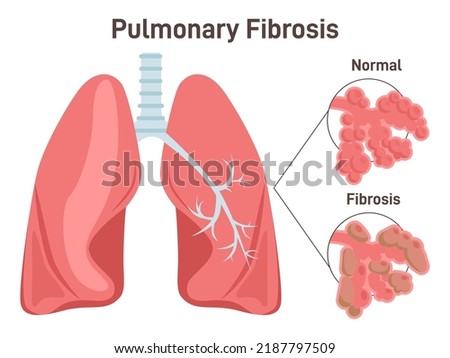 Pulmonary fibrosis. Lung tissue disease. Damaged, thickened, stiff tissue. Anatomy of human body, respiratory system studying. Flat vector illustration Royalty-Free Stock Photo #2187797509