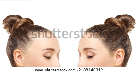 Thinning hair and hair loss,female pattern baldness,Hair transplant Royalty-Free Stock Photo #2188140319