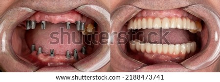 before and after pictures of dental implants and press ceramic crowns Royalty-Free Stock Photo #2188473741