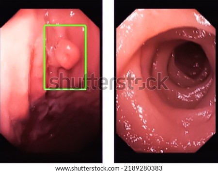 Endoscope technology concept. 3d rendering endoscopic inside of intestine gastric polyp. Royalty-Free Stock Photo #2189280383