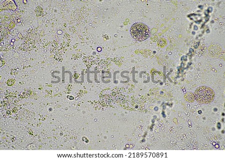 Coughing up mucus and phlegm from a chest infection from a virus and bacteria infection, looking at it under the microscope, with cells and microorganisms. Bacteria and skin cells close up Royalty-Free Stock Photo #2189570891