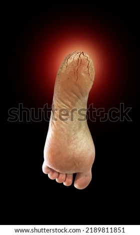 Decorate pictures of cracked heels, dry feet and dry skin on a black background.