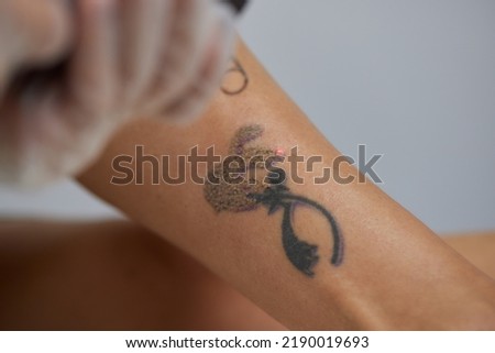 Young woman undergoing laser tattoo removal procedure in salon, closeup. Royalty-Free Stock Photo #2190019693