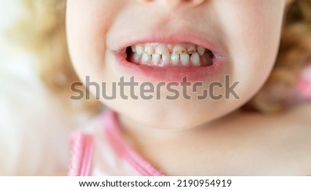 Caries in children's teeth. Initial stage. Close-up. Royalty-Free Stock Photo #2190954919