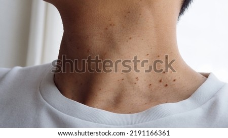 Many skin tags or Acrochordon on the neck They are small soft and common benign on the human skin especially on adult skin and can be irritated by shaving and daily clothing   