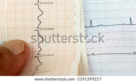 Heart rhythm ekg note on paper. Doctors use it to analyze heart disease treatment. illustration on a white background A stapler and a syringe were placed over it.