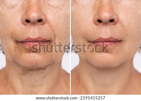 Lower part of face and neck of an elderly woman with signs of skin aging before after facelift, plastic surgery. Age-related changes, flabby sagging skin, wrinkles, creases, puffiness. Rejuvenation Royalty-Free Stock Photo #2191415257