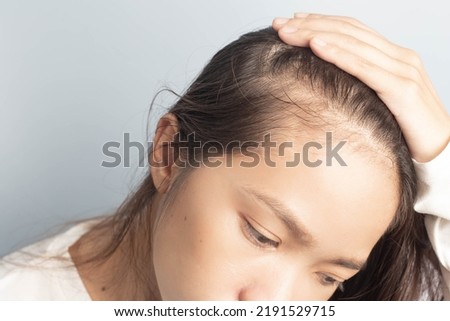 Young women stressed and having hair loss, thinning hair Royalty-Free Stock Photo #2191529715