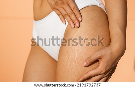 Stretch marks on female legs. A woman's hand holds a fat cellulite and a stretch mark on her leg. Cellulite close-up. Royalty-Free Stock Photo #2191792737