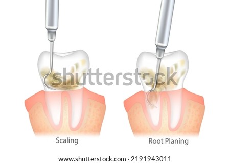 Difference of the Periodontal Scaling and Root Planing. Oral hygiene and conventional periodontal therapy. Medically accurate of human teeth cleaning treatment. Dental scale. Royalty-Free Stock Photo #2191943011
